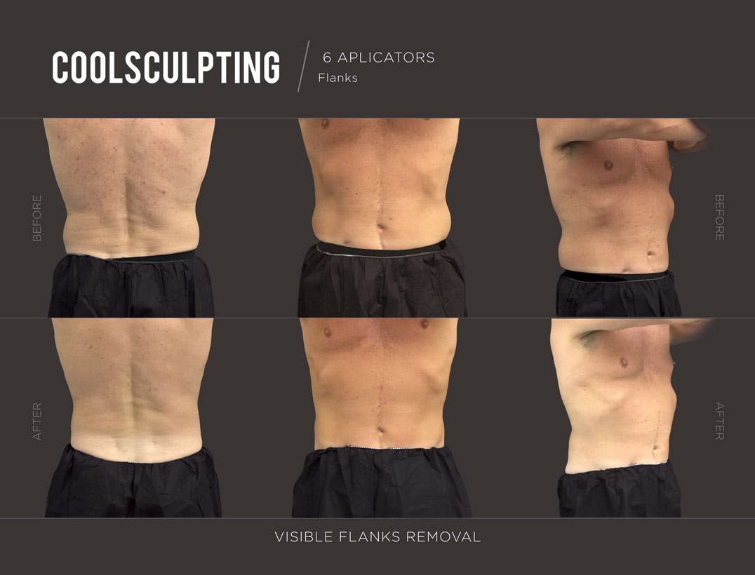 CoolSculpting Before and After 75