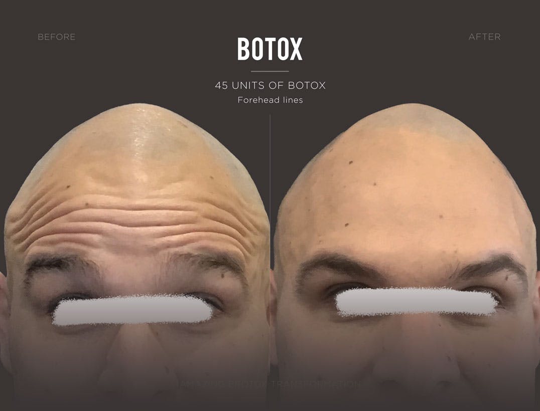 botox-new-york-trifectamedspa.jpg