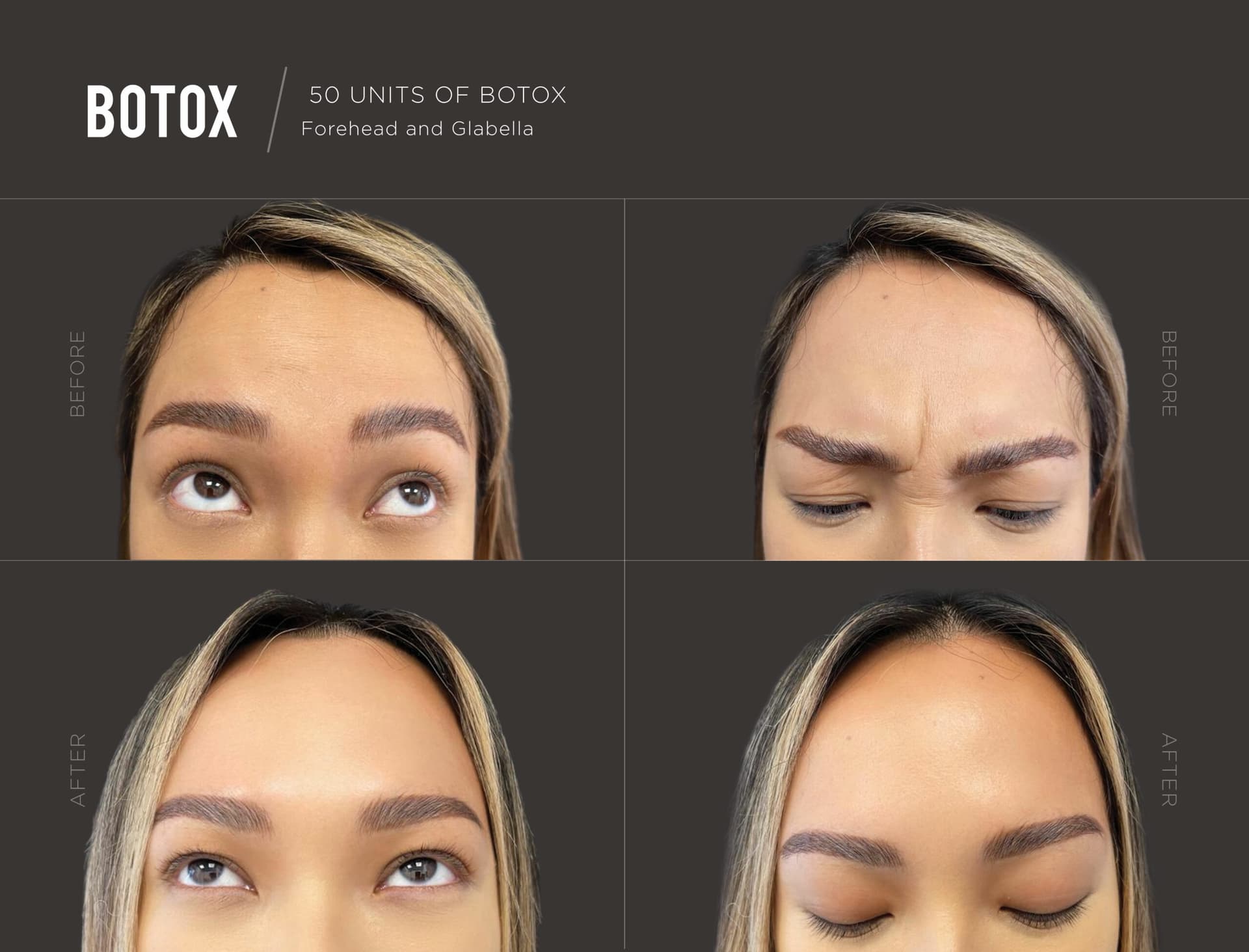 Botox Specials & Deals in NYC & Long Island - Trifecta Med Spa