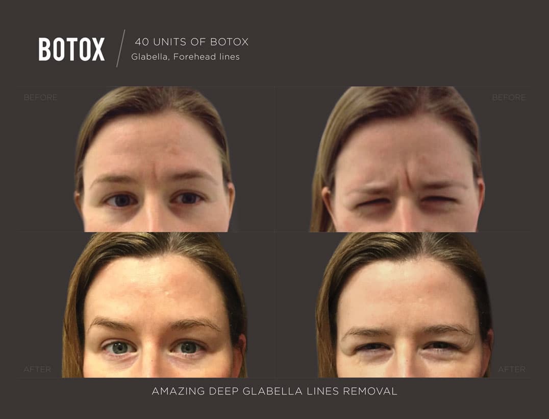Before After Photos Trifecta Med Spa Before after photos trifecta med spa