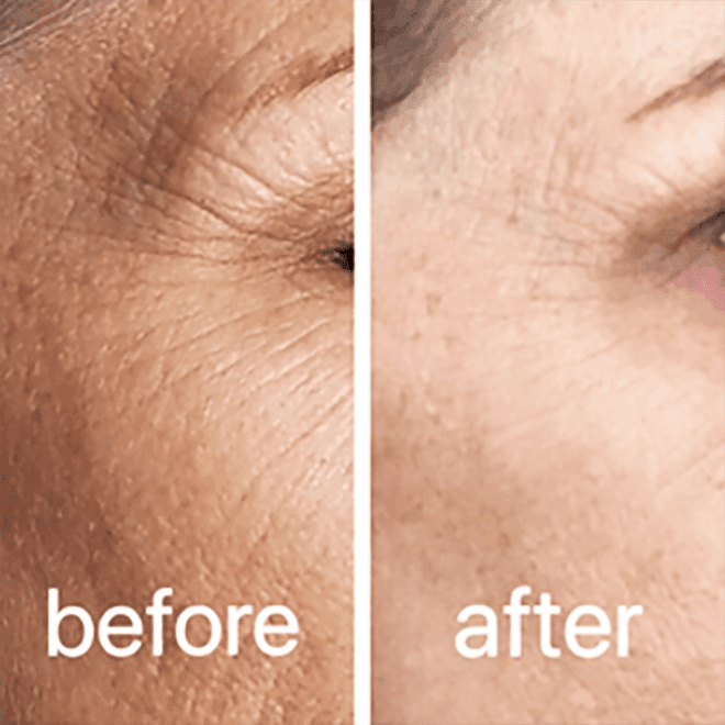 CO2 laser before and after result 1