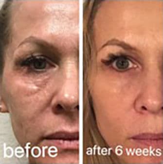 CO2 laser before and after result 2