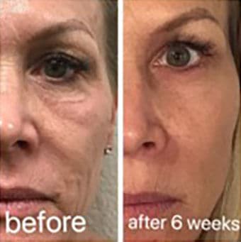 CO2 laser before and after result 3