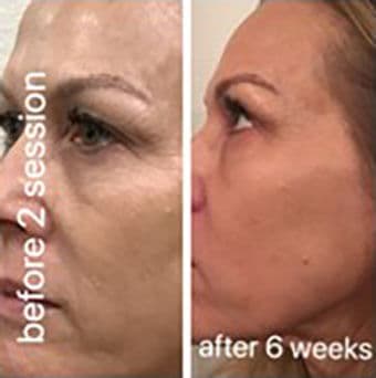 CO2 laser before and after result 4