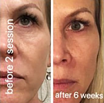 CO2 laser before and after result 5