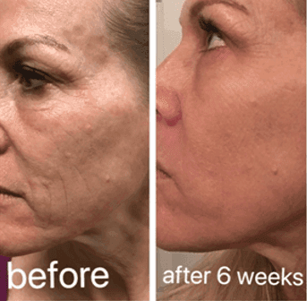 CO2 laser before and after result 6