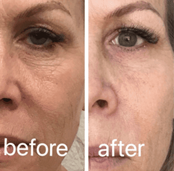 CO2 laser before and after result 7