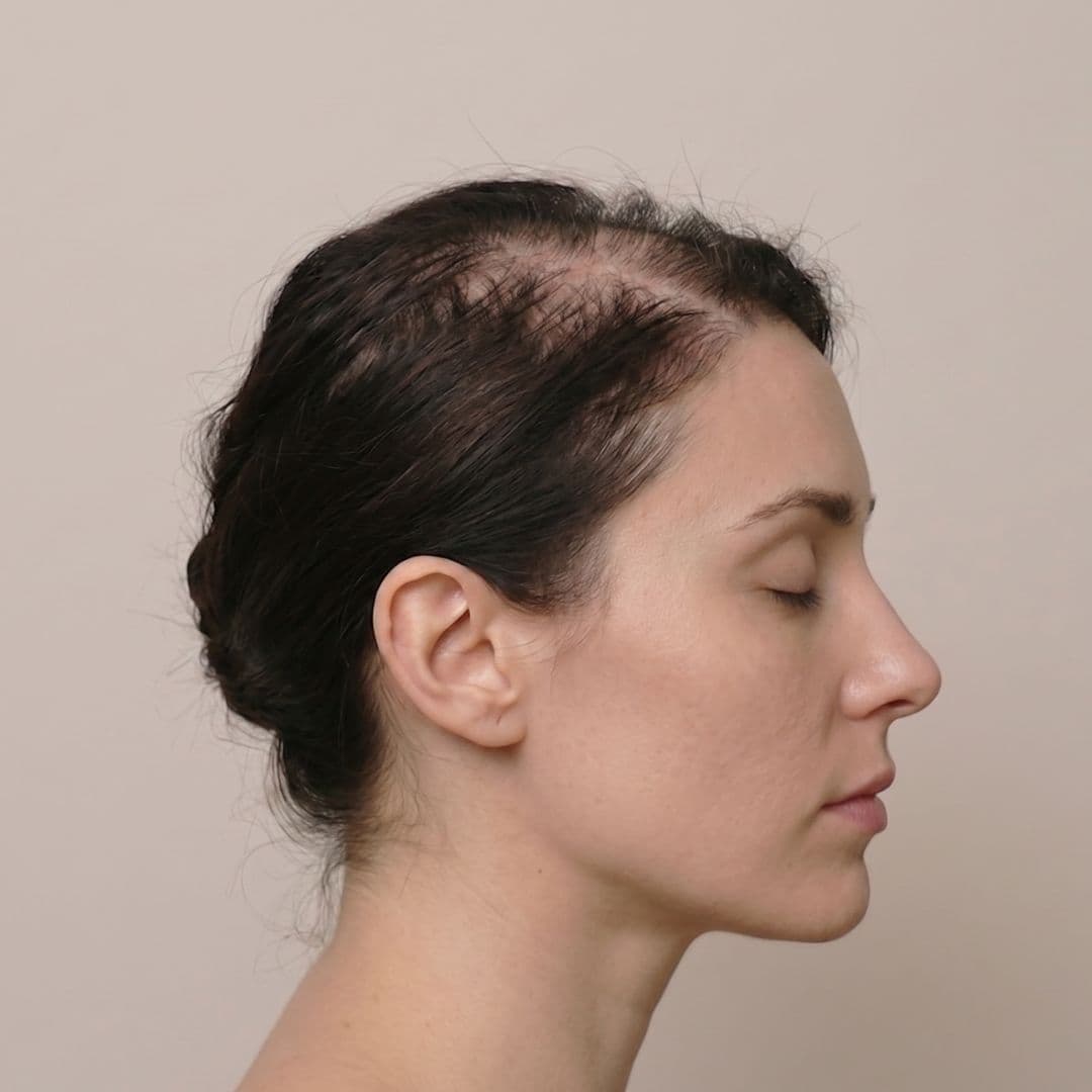 Alopecia Areata (AA)