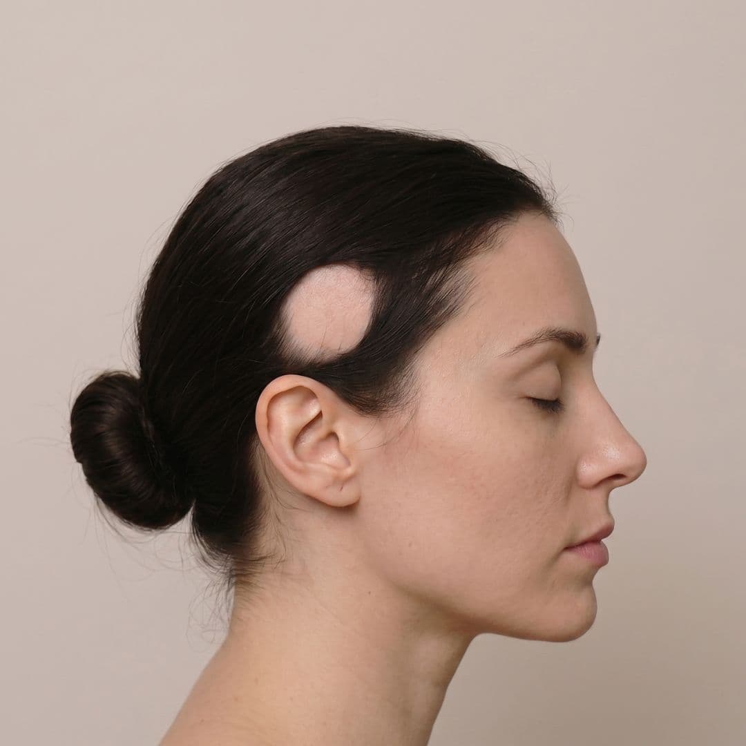 Androgenetic Alopecia (AGA)