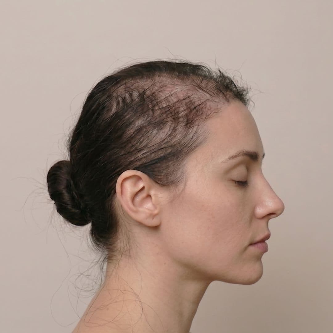 Telogen Effluvium