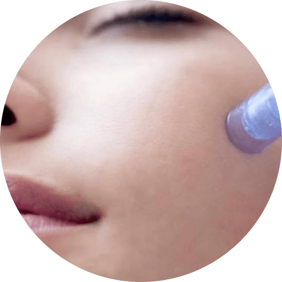 needling.jpg.png