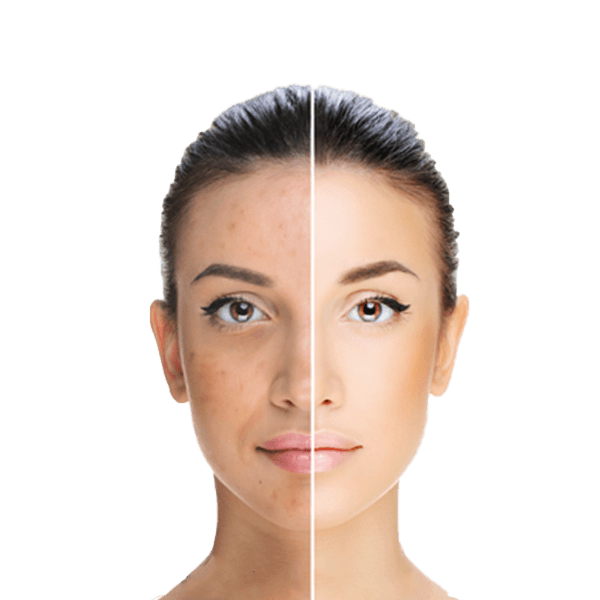 Chemical Peel and ViPeel Treatment at Trifecta Med Spa NYC