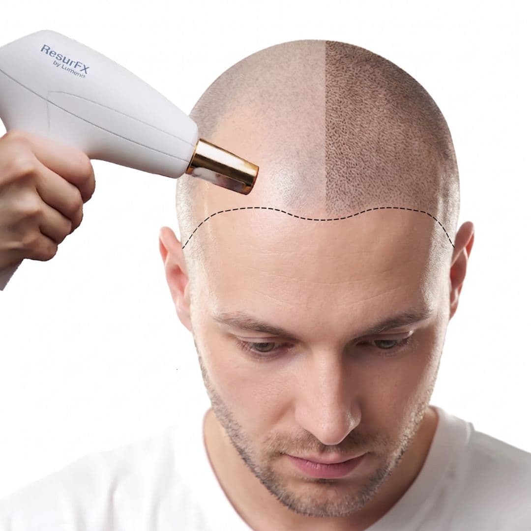 Lumenis FoLix laser hair restoration protocol at Trifecta Med Spa NYC