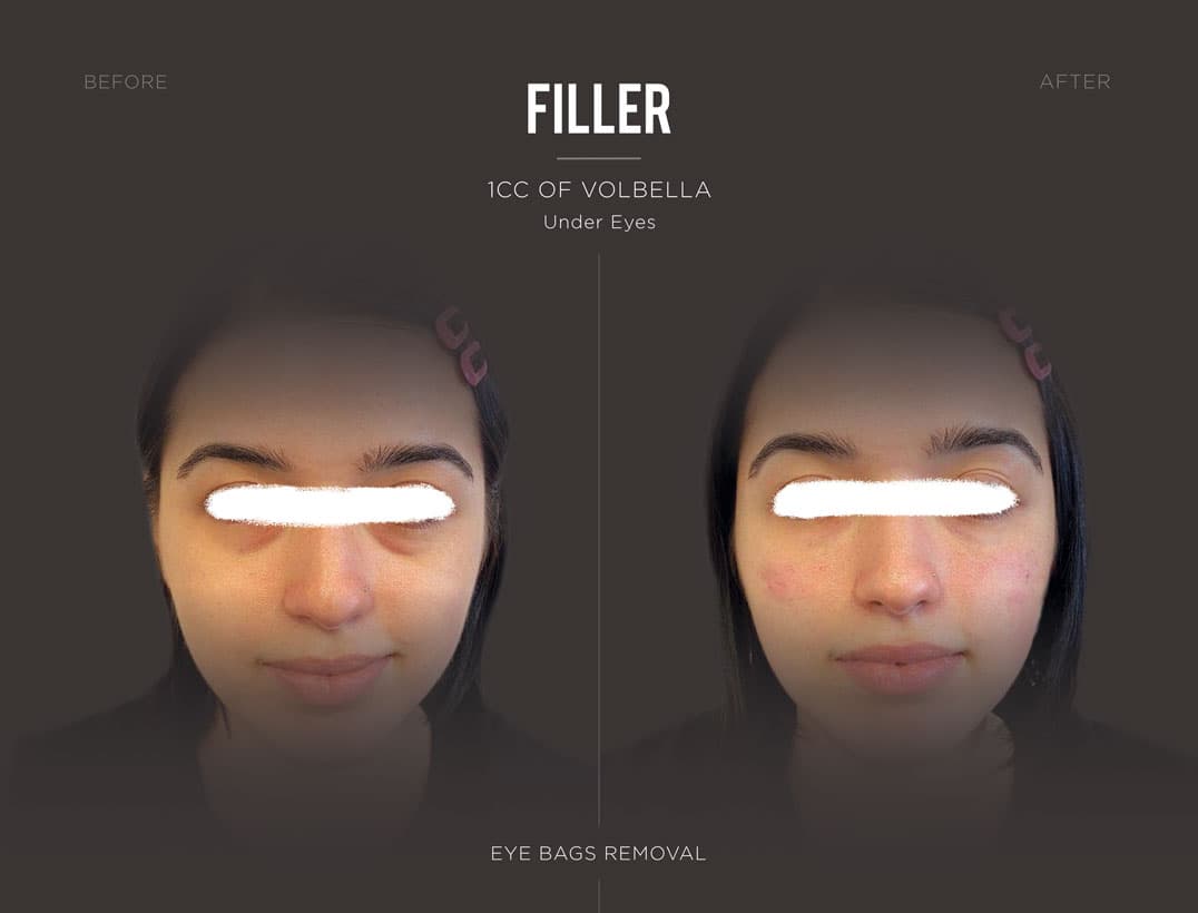 Non-Surgical Eye Bag Reduction