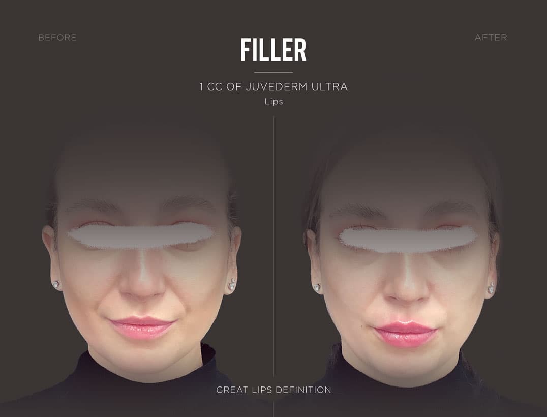 Juvederm Volbella Lip Enhancement