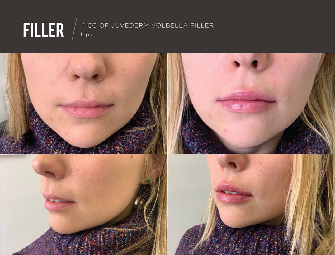 Symmetrical Lip Shaping