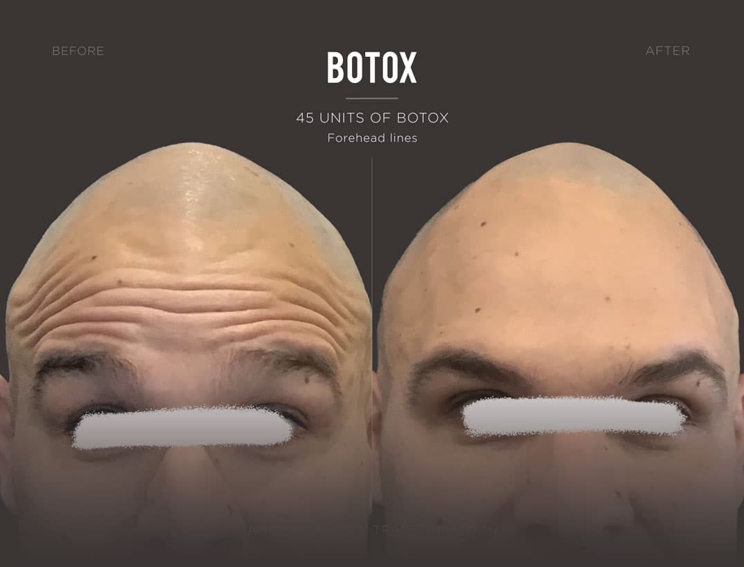 Botox Glabellar Wrinkle Reduction