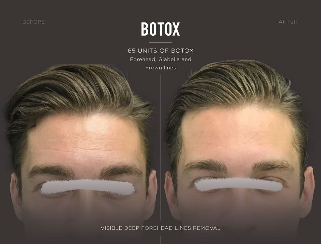 Botox NYC Male Patient Frown Line Result