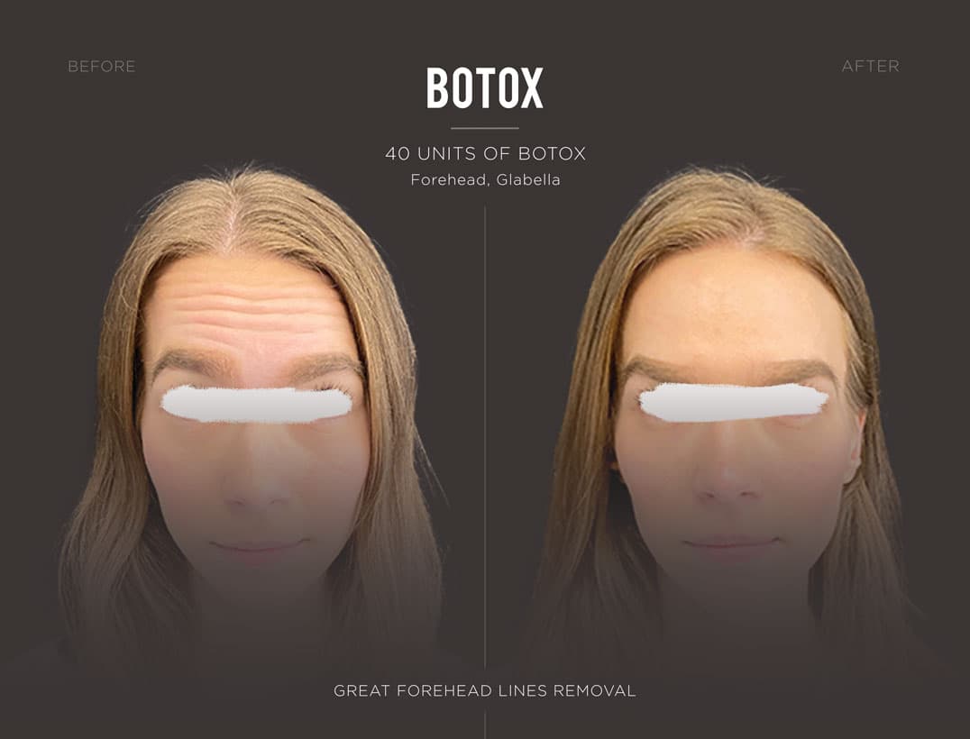 Botox NYC Woman Forehead Smoothing Result
