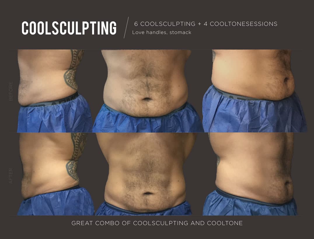 CoolSculpting Flank Reduction Man