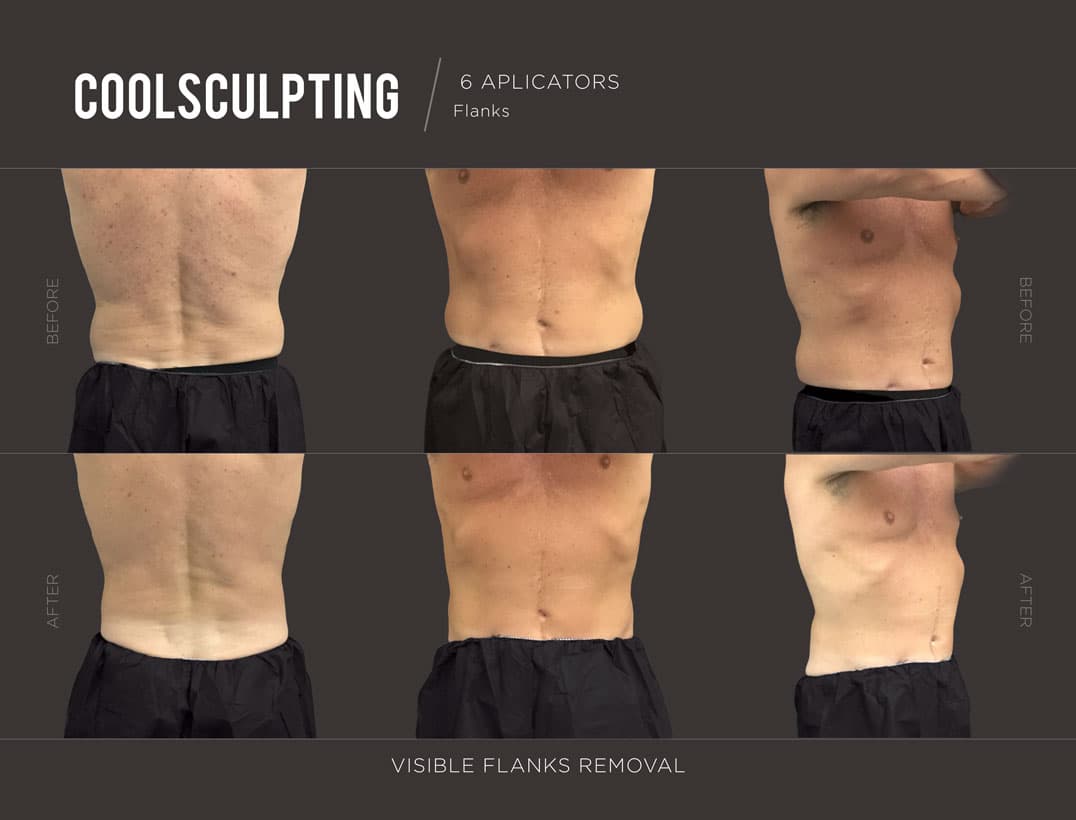 CoolSculpting Male Body Contouring