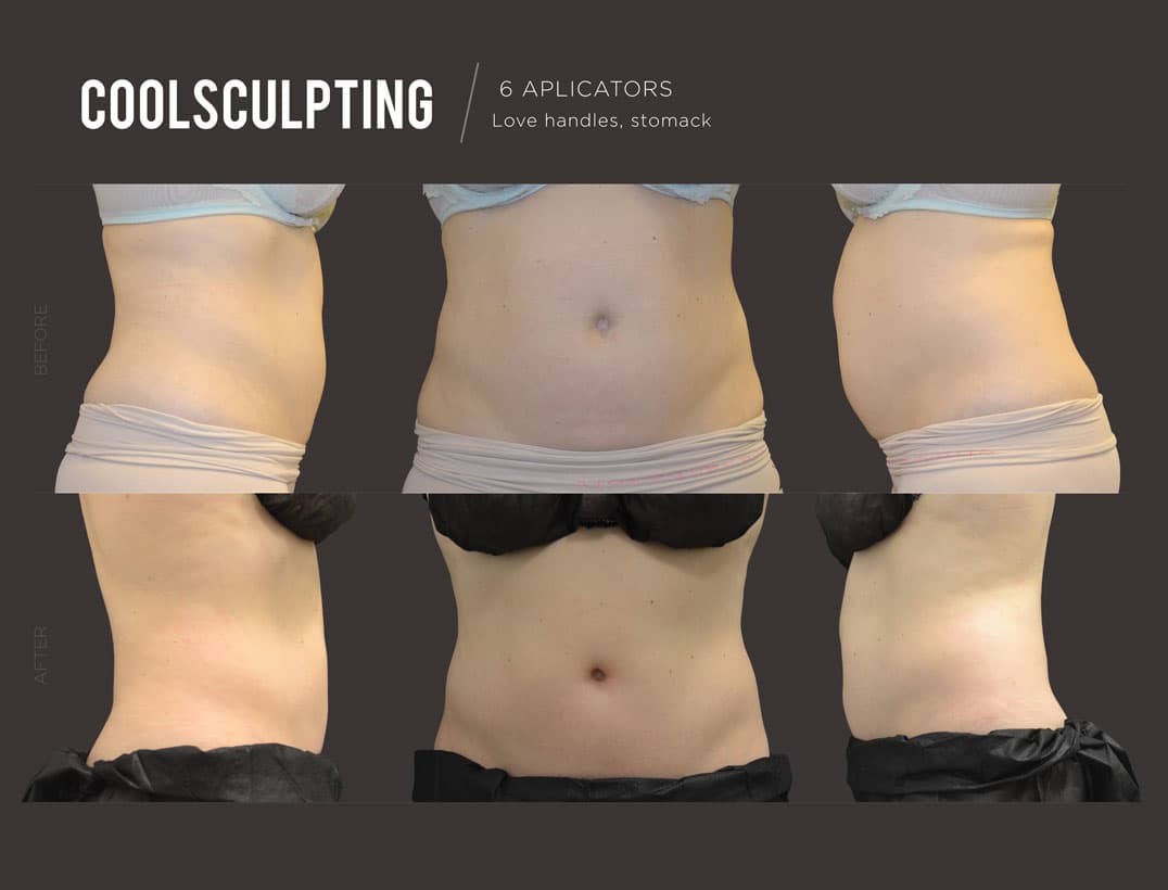 CoolSculpting Abdominal Fat Freezing