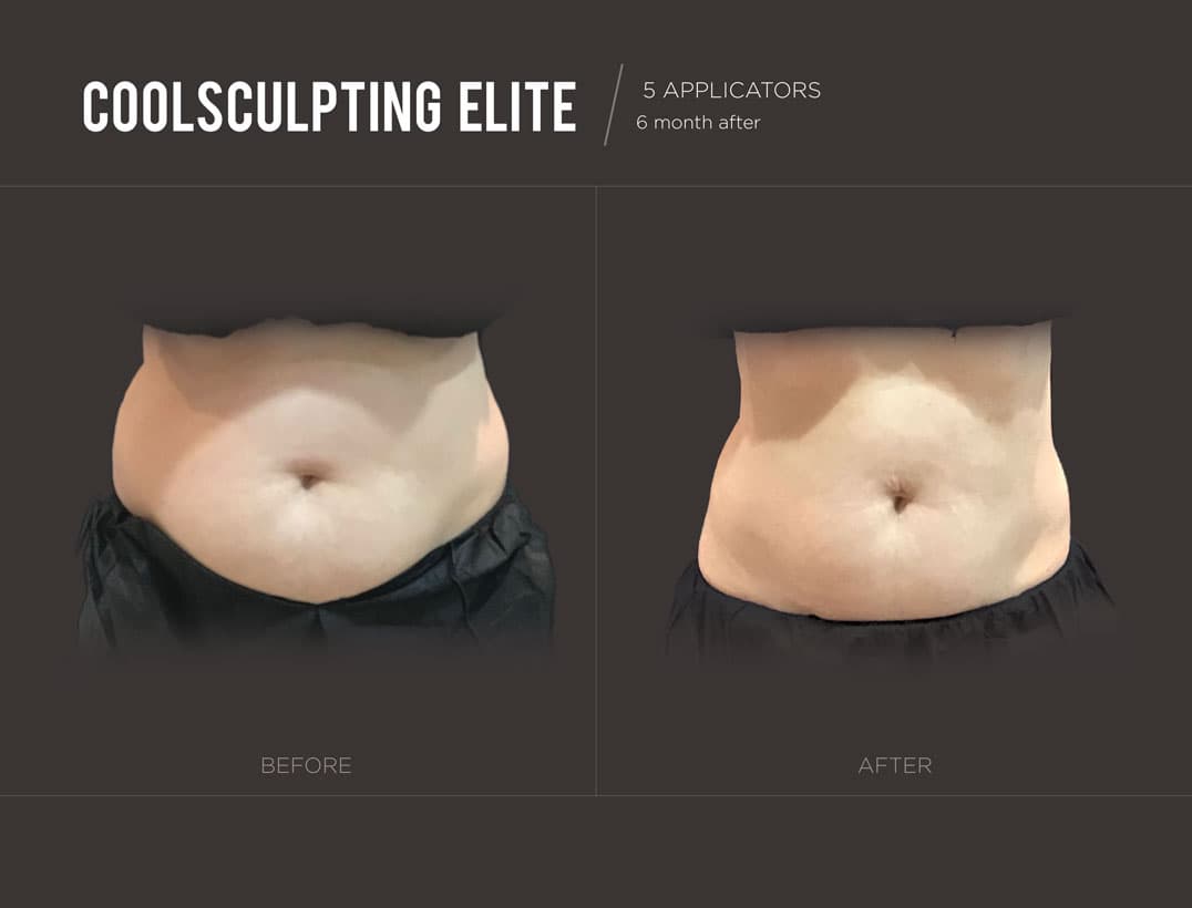 CoolSculpting Abdomen Reduction Woman