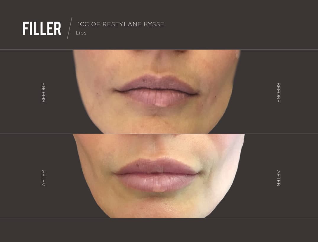 Juvederm Dermal Filler Results