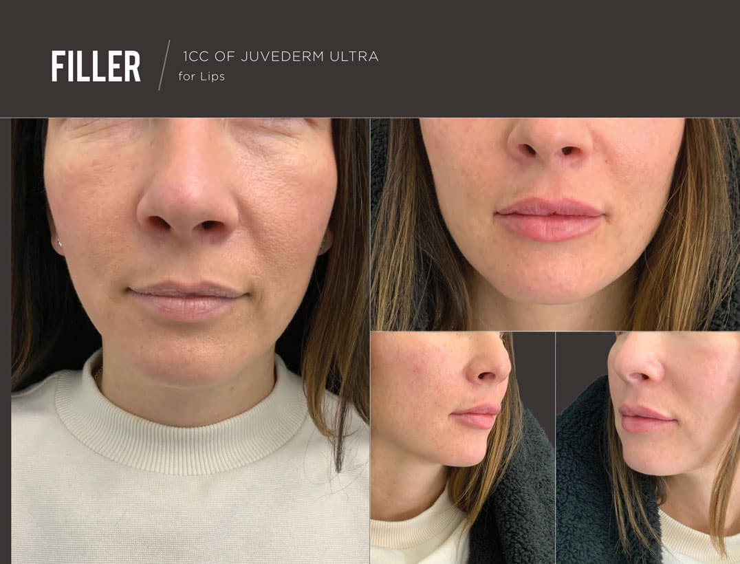 Facial & Lip Dermal Filler Outcome