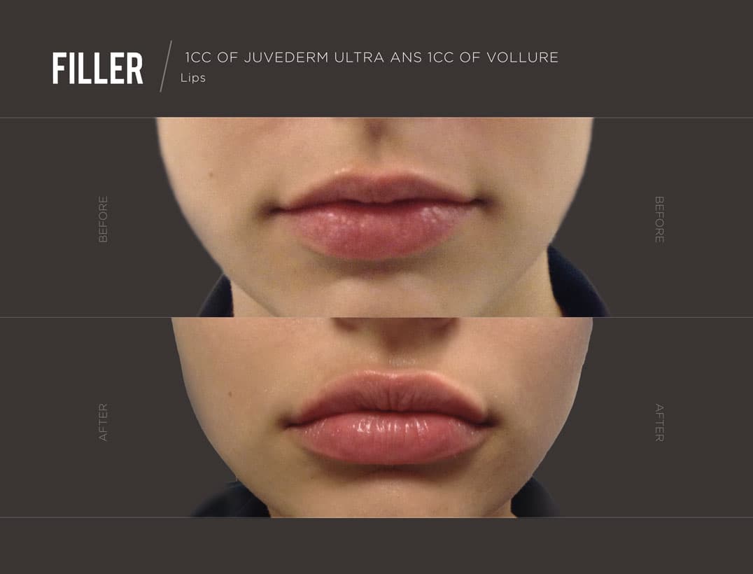 Lip Filler Before & After NYC