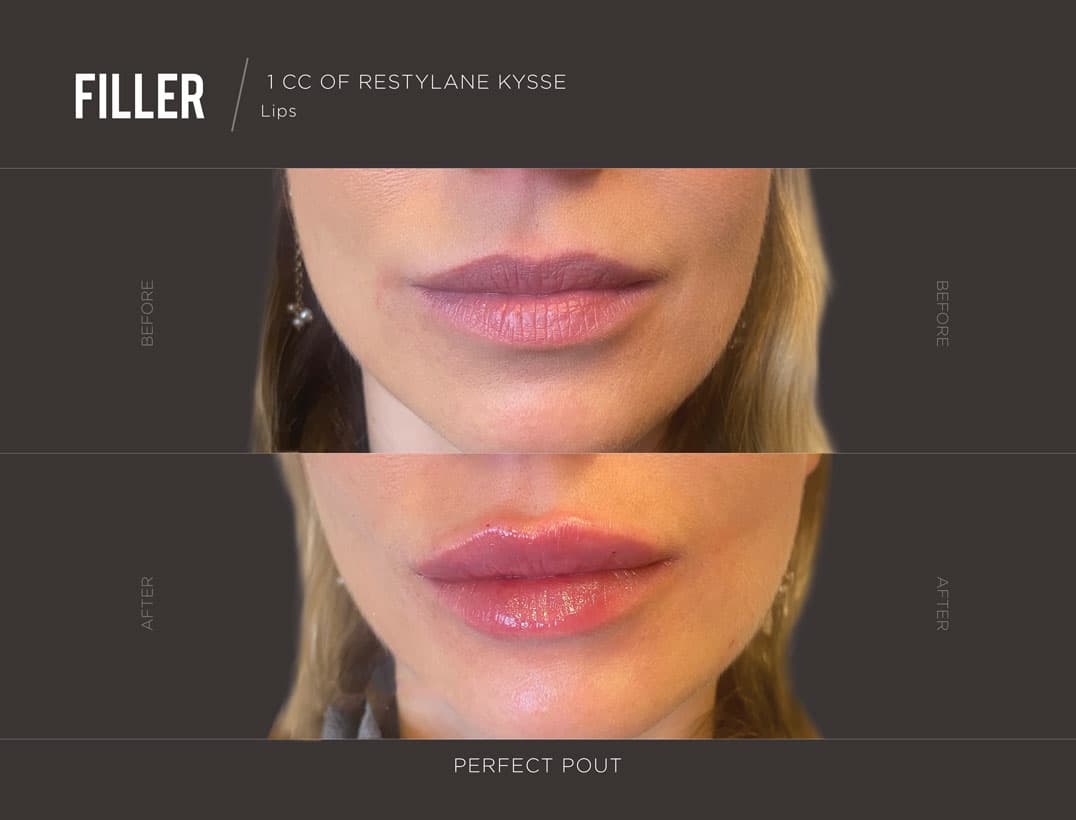 Natural Lip Augmentation Result