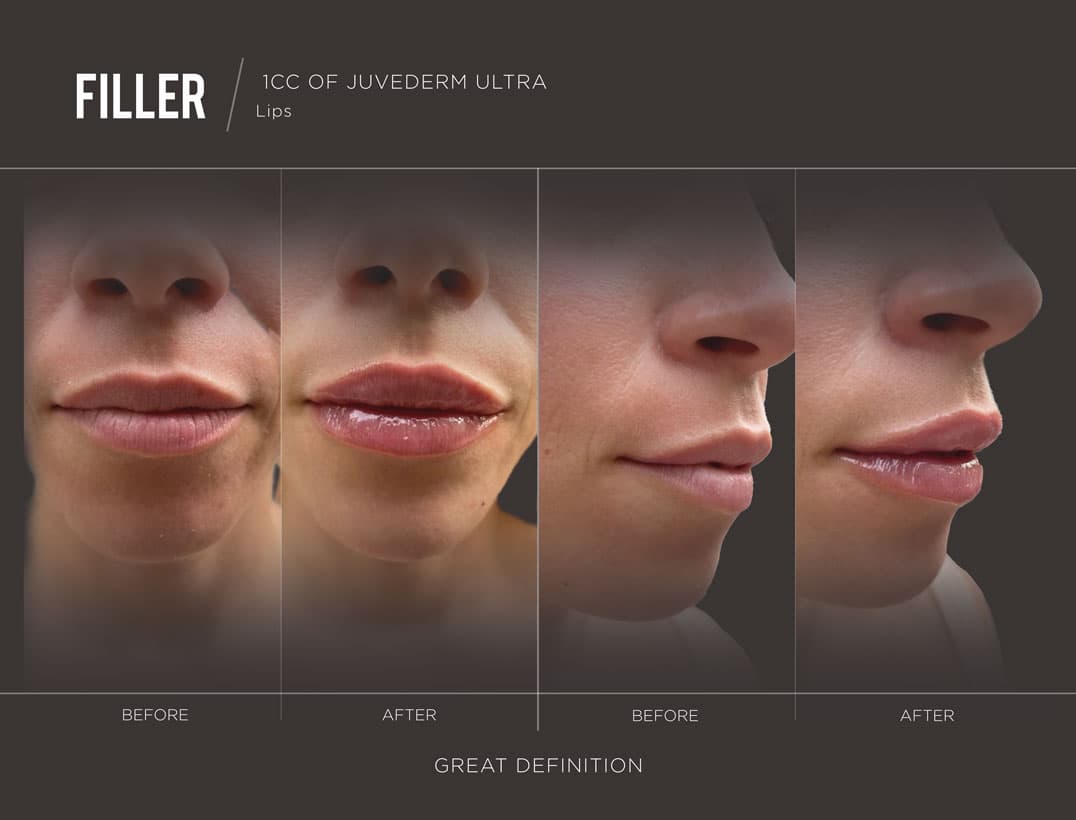 Balanced Upper and Lower Lip Ratio