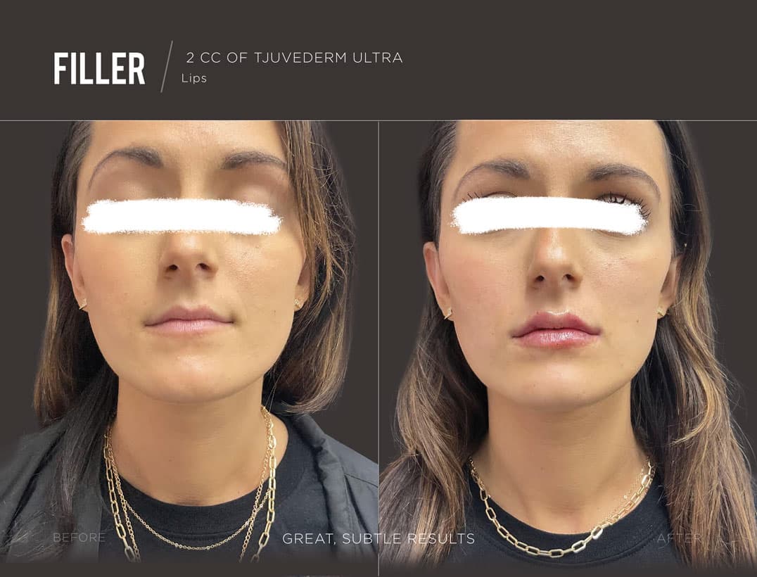 Lip Filler Contour & Hydration
