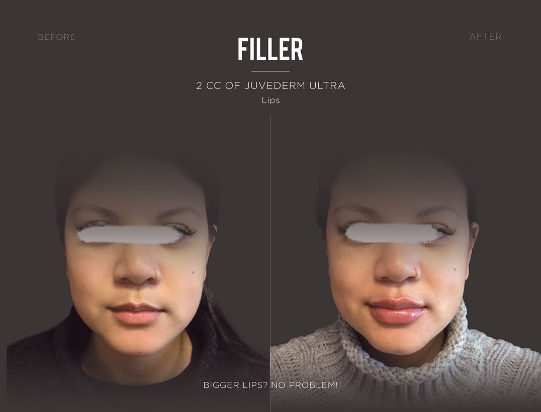 Full Lip Volume Restoration
