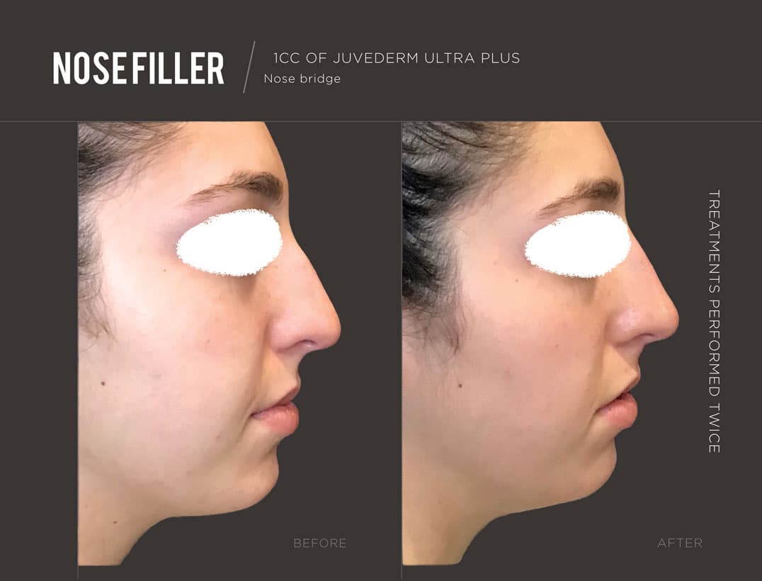 Liquid Rhinoplasty Dorsal Hump Smoothing