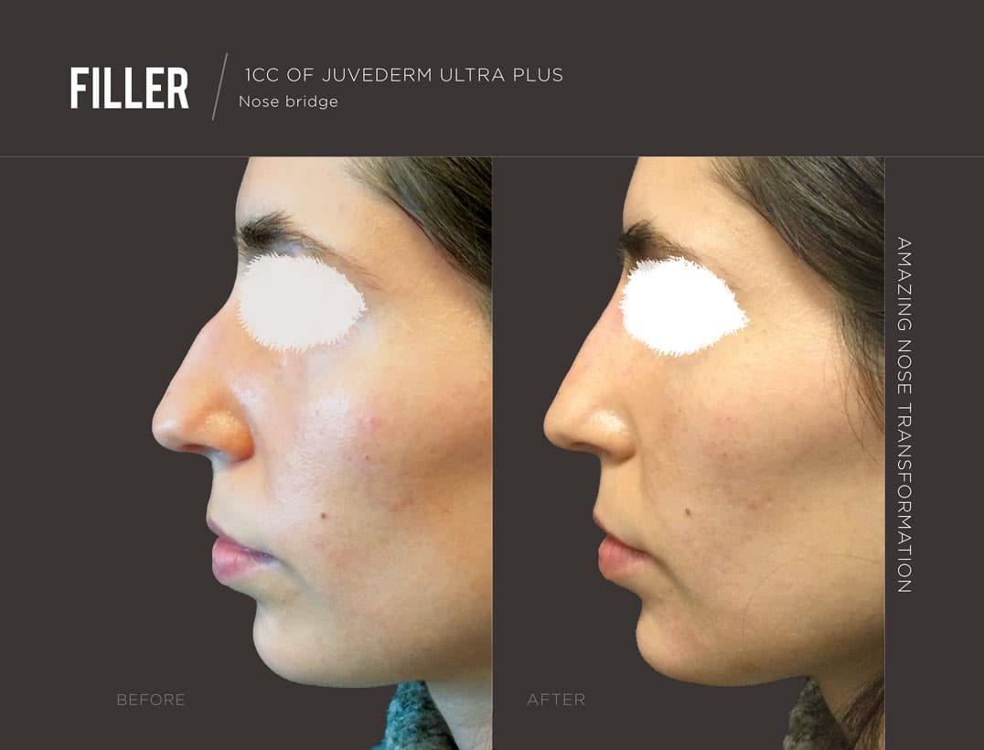 Non-Surgical Nose Transformation