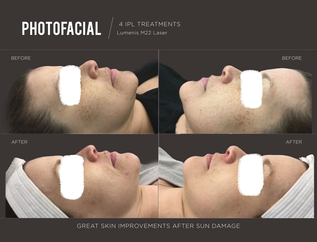 IPL Skin Tone & Redness Clearance