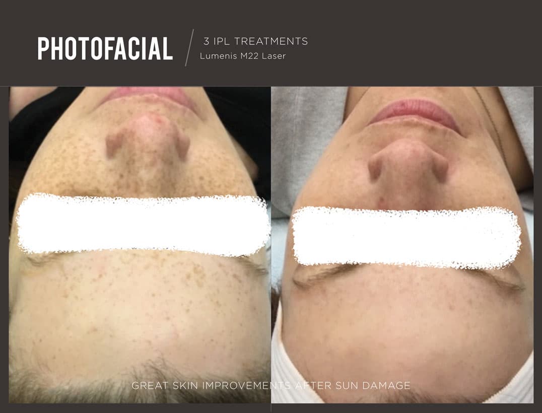 IPL Sun Damage & Dark Spot Removal