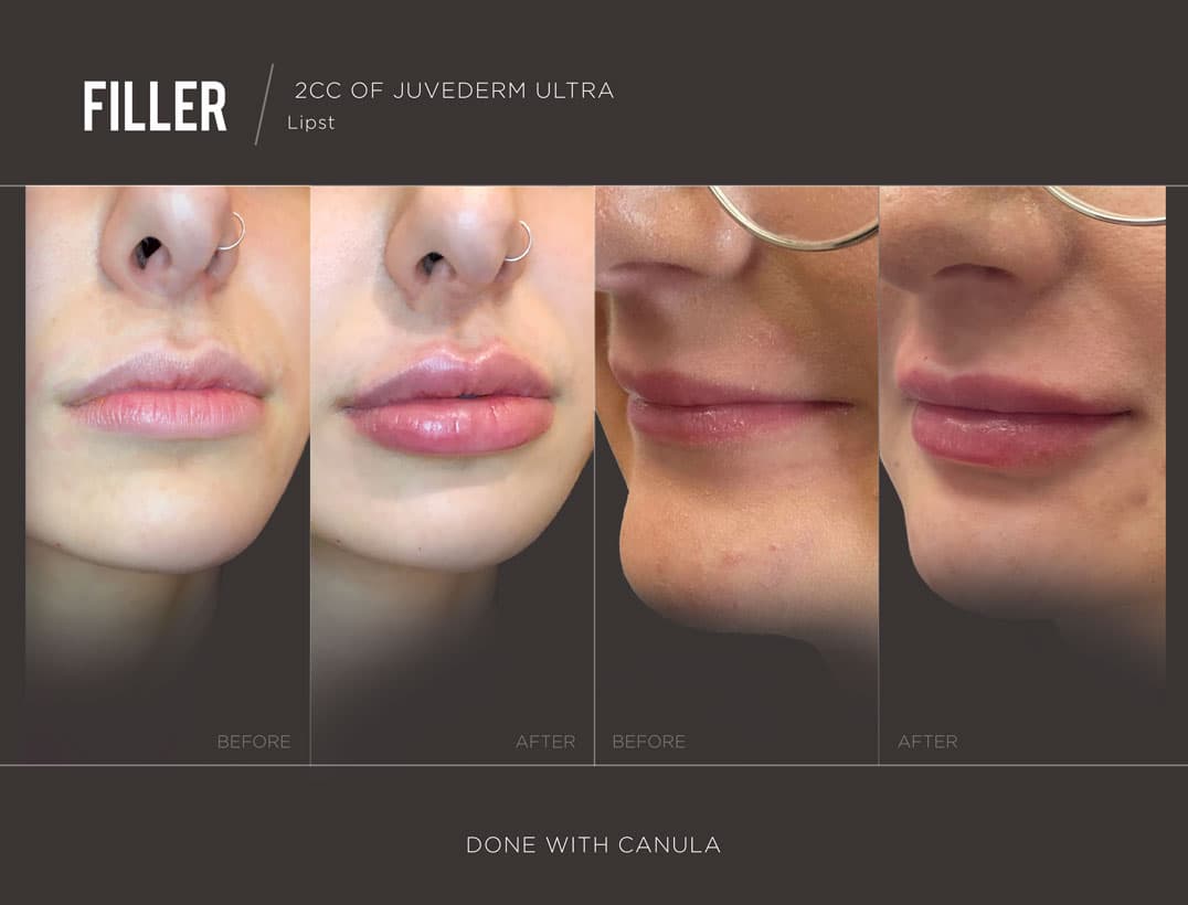 Precision Lip Filler Technique
