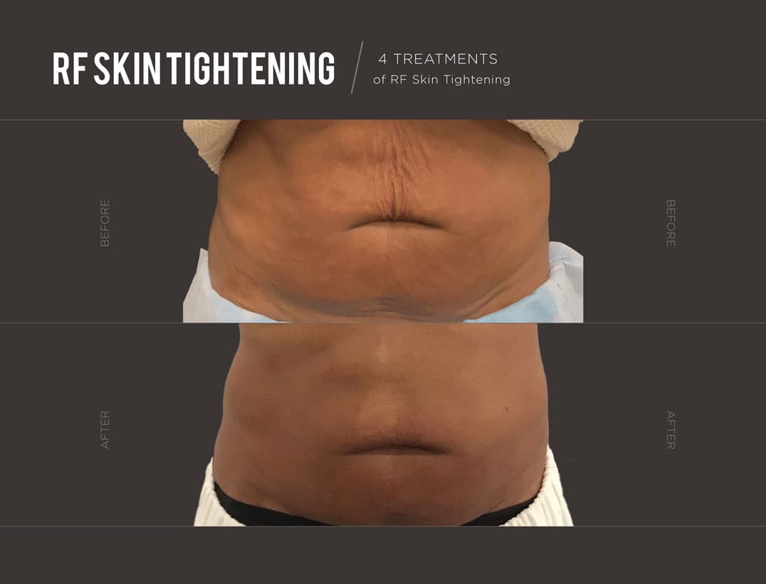 RF Skin Tightening & Collagen Remodeling