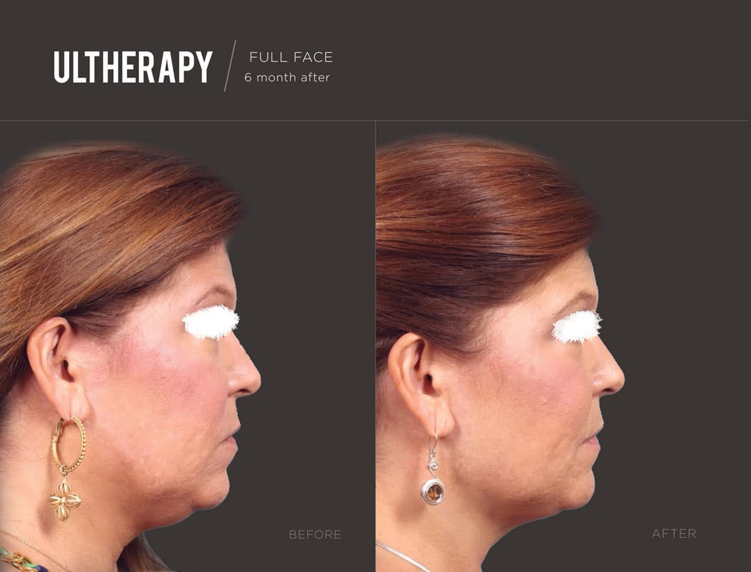 Ultherapy Lower Face & Neck Tightening
