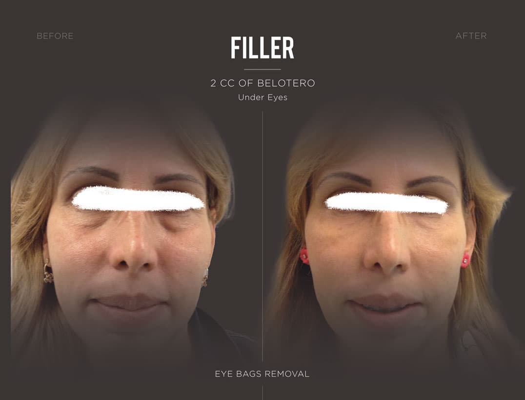 Under Eye Hollow Tear Trough Filler