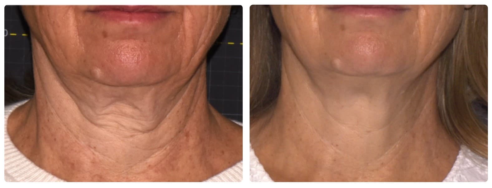 Sofwave before and after treatment results NYC