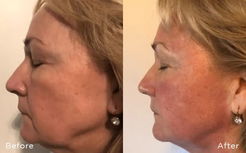 RF Microneedling before and after results NYC