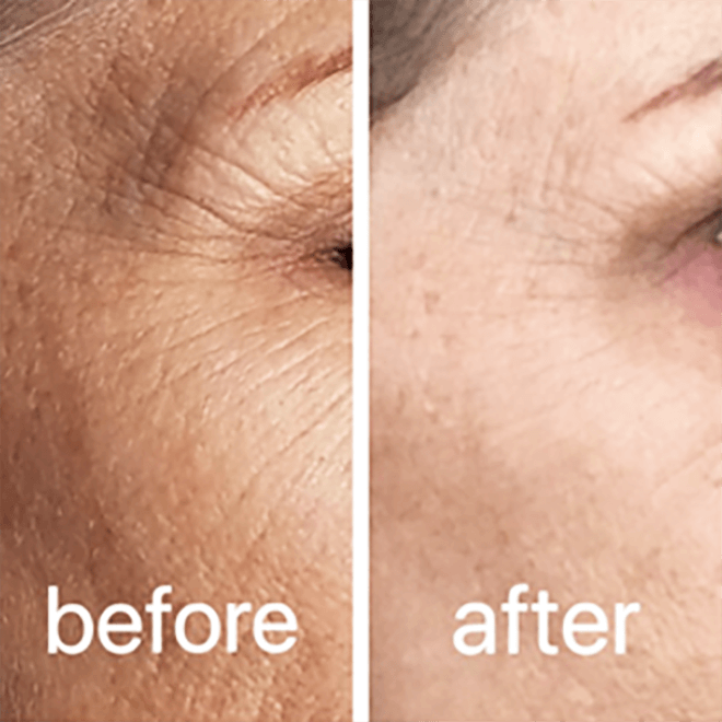 CO2 laser before and after result 1
