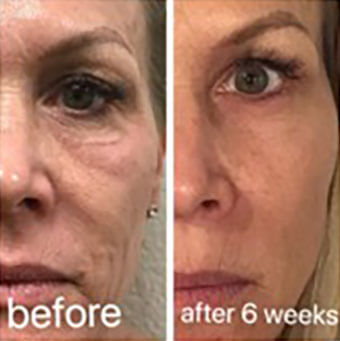 CO2 laser before and after result 3