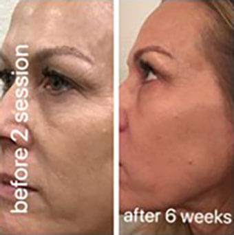 CO2 laser before and after result 4