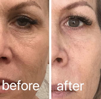 CO2 laser before and after result 7
